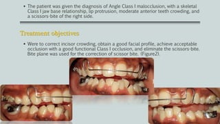Treatment objectives
 The patient was given the diagnosis of Angle Class I malocclusion, with a skeletal
Class I jaw base relationship, lip protrusion, moderate anterior teeth crowding, and
a scissors-bite of the right side.
 Were to correct incisor crowding, obtain a good facial profile, achieve acceptable
occlusion with a good functional Class I occlusion, and eliminate the scissors-bite.
Bite plane was used for the correction of scissor bite. (Figure2).
 