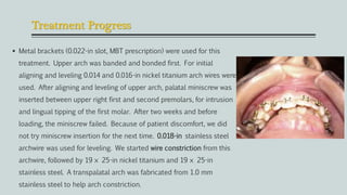 Treatment Progress
 Metal brackets (0.022-in slot, MBT prescription) were used for this
treatment. Upper arch was banded and bonded first. For initial
aligning and leveling 0.014 and 0.016-in nickel titanium arch wires were
used. After aligning and leveling of upper arch, palatal miniscrew was
inserted between upper right first and second premolars, for intrusion
and lingual tipping of the first molar. After two weeks and before
loading, the miniscrew failed. Because of patient discomfort, we did
not try miniscrew insertion for the next time. 0.018-in stainless steel
archwire was used for leveling. We started wire constriction from this
archwire, followed by 19 × 25-in nickel titanium and 19 × 25-in
stainless steel. A transpalatal arch was fabricated from 1.0 mm
stainless steel to help arch constriction.
 