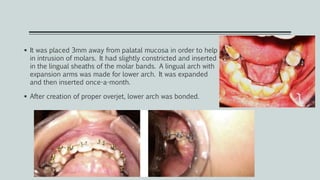  It was placed 3mm away from palatal mucosa in order to help
in intrusion of molars. It had slightly constricted and inserted
in the lingual sheaths of the molar bands. A lingual arch with
expansion arms was made for lower arch. It was expanded
and then inserted once-a-month.
 After creation of proper overjet, lower arch was bonded.
 