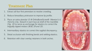 Treatment Plan
1. Extract all four first premolars to resolve crowding.
2. Reduce bimaxillary protrusion to improve lip profile.
3. Place an extra-alveolar (E-A) OrthoBoneScrew® (Newton’s A,
Hsinchu City, Taiwan) in each buccal shelf of the mandible
(Fig. 11) to serve as anchorage for elastics to correct the
lingually tipped molars (#18, 19 and 31).
4. Intermaxillary elastics to correct the sagittal discrepancy.
5. Detail occlusion with finishing bends and settling elastics.
6. Retention with clear overlay retainers in both arches.
 
