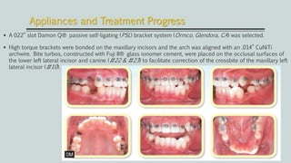  A 022” slot Damon Q® passive self-ligating (PSL) bracket system (Ormco, Glendora, CA) was selected.
 High torque brackets were bonded on the maxillary incisors and the arch was aligned with an .014” CuNiTi
archwire. Bite turbos, constructed with Fuji II® glass ionomer cement, were placed on the occlusal surfaces of
the lower left lateral incisor and canine (#22 & #23) to facilitate correction of the crossbite of the maxillary left
lateral incisor (#10).
Appliances and Treatment Progress
 