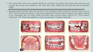  One month later, when the crossbite (#10) was corrected, the anterior bite turbos were removed, and
occlusal bite turbos were bonded on the lower first molar (#30) and the lower left second premolar
(#20).
 Standard torque brackets were then bonded on all mandibular teeth, except the second molars, and an
.014” CuNiTi archwire was placed. At the same appointment, buttons were bonded on the lingual surfaces
of the mandibular left 1st molar (#19), and both lower second molars (#18 & 31). Cross elastics
(Chipmunk 1/8” 3.5oz) were applied to correct the posterior crossbites bilaterally.
 