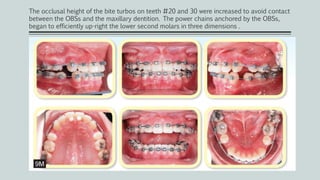 The occlusal height of the bite turbos on teeth #20 and 30 were increased to avoid contact
between the OBSs and the maxillary dentition. The power chains anchored by the OBSs,
began to efficiently up-right the lower second molars in three dimensions .
 