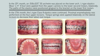 In the 15th month, an .016x.025” SS archwire was placed on the lower arch. L-type elastics
(Bear 1/4” 4.5oz) were applied from the upper canines to the lower second molars, bilaterally.
The paths of the elastics were positioned gingival to the bracket on the lower first molars
In the 17th month, the L-type Class II elastics were continued. Proximal enameloplasty was
performed on the four upper incisors. Torque springs were applied bilaterally on the lateral
incisors to decrease their labial root torque.
 