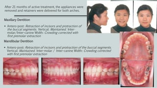 Maxillary Dentition
 Antero-post: Retraction of incisors and protraction of
the buccal segments. Vertical: Maintained. Inter-
molar/Inter-canine Width: Crowding corrected with
first premolar extraction
After 21 months of active treatment, the appliances were
removed and retainers were delivered for both arches.
Mandibular Dentition
 Antero-post: Retraction of incisors and protraction of the buccal segments.
Vertical: Maintained. Inter-molar / Inter-canine Width: Crowding corrected
with first premolar extraction
 