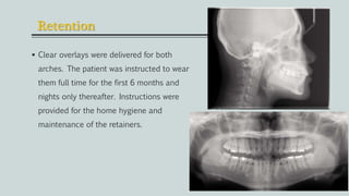 Retention
 Clear overlays were delivered for both
arches. The patient was instructed to wear
them full time for the first 6 months and
nights only thereafter. Instructions were
provided for the home hygiene and
maintenance of the retainers.
 
