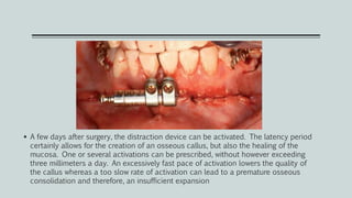  A few days after surgery, the distraction device can be activated. The latency period
certainly allows for the creation of an osseous callus, but also the healing of the
mucosa. One or several activations can be prescribed, without however exceeding
three millimeters a day. An excessively fast pace of activation lowers the quality of
the callus whereas a too slow rate of activation can lead to a premature osseous
consolidation and therefore, an insufficient expansion
 