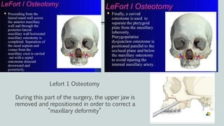 Lefort 1 Osteotomy
During this part of the surgery, the upper jaw is
removed and repositioned in order to correct a
“maxillary deformity”
 