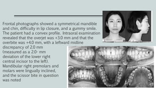 Frontal photographs showed a symmetrical mandible
and chin, difficulty in lip closure, and a gummy smile.
The patient had a convex profile. Intraoral examination
revealed that the overjet was +3.0 mm and that the
overbite was +4.0 mm, with a leftward midline
discrepancy of 2.0 mm
(measured as a 2.0- mm
deviation of the lower right
central incisor to the left).
Mandibular right premolars and
molars were lingually inclined,
and the scissor bite in question
was noted
 