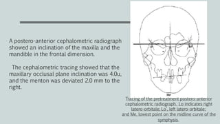 A postero-anterior cephalometric radiograph
showed an inclination of the maxilla and the
mandible in the frontal dimension.
The cephalometric tracing showed that the
maxillary occlusal plane inclination was 4.0u,
and the menton was deviated 2.0 mm to the
right.
Tracing of the pretreatment postero-anterior
cephalometric radiograph. Lo indicates right
latero-orbitale; Lo’, left latero-orbitale;
and Me, lowest point on the midline curve of the
symphysis.
 