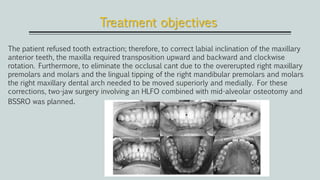 Treatment objectives
The patient refused tooth extraction; therefore, to correct labial inclination of the maxillary
anterior teeth, the maxilla required transposition upward and backward and clockwise
rotation. Furthermore, to eliminate the occlusal cant due to the overerupted right maxillary
premolars and molars and the lingual tipping of the right mandibular premolars and molars
the right maxillary dental arch needed to be moved superiorly and medially. For these
corrections, two-jaw surgery involving an HLFO combined with mid-alveolar osteotomy and
BSSRO was planned.
 