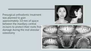 Presurgical orthodontic treatment
was planned to gain
approximately 3.0 mm of space
between the maxillary central
incisors to protect their roots from
damage during the mid-alveolar
osteotomy
 