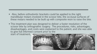  Also, before orthodontic brackets could be applied to the right
mandibular molars involved in the scissor bite, the occlusal surfaces of
these molars needed to be built up with composite resin to raise the bite.
 This treatment plan was designed to deliver a faster resolution of the
scissor bite by orthognathic surgery. The procedures, risks, advantages,
disadvantages, and costs were explained to the patient, and she was able
to give full informed consent prior to the
start of treatment.
 