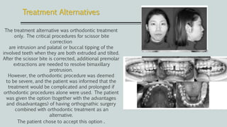 The treatment alternative was orthodontic treatment
only. The critical procedures for scissor bite
correction
are intrusion and palatal or buccal tipping of the
involved teeth when they are both extruded and tilted.
After the scissor bite is corrected, additional premolar
extractions are needed to resolve bimaxillary
protrusion.
However, the orthodontic procedure was deemed
to be severe, and the patient was informed that the
treatment would be complicated and prolonged if
orthodontic procedures alone were used. The patient
was given the option (together with the advantages
and disadvantages) of having orthognathic surgery
combined with orthodontic treatment as an
alternative.
The patient chose to accept this option .
Treatment Alternatives
 