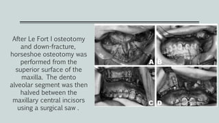 After Le Fort I osteotomy
and down-fracture,
horseshoe osteotomy was
performed from the
superior surface of the
maxilla. The dento
alveolar segment was then
halved between the
maxillary central incisors
using a surgical saw .
 