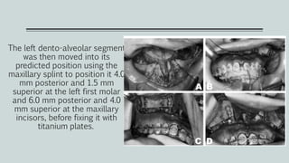 The left dento-alveolar segment
was then moved into its
predicted position using the
maxillary splint to position it 4.0
mm posterior and 1.5 mm
superior at the left first molar
and 6.0 mm posterior and 4.0
mm superior at the maxillary
incisors, before fixing it with
titanium plates.
 