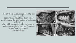 The left dento-alveolar segment. The right
dento-alveolar
segment was moved into its predicted
position using the resin plate and continuous
archwire to
align it 6.0 mm posterior, 8.0 mm superior,
and 4.0 mm medial at the right first molar
before fixing it, again with
titanium plates .
 