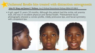 Unilateral Brodie bite treated with distraction osteogenesis
John W. King, and James C. Wallace, Am J Orthod Dentofacial Orthop 2004;125:500-9
 A girl, aged 11 years 10 months, Although the patient had the sickle cell anemia
trait, she was in excellent physical and dental health. Pretreatment facial
photographs showed a convex profile, mildly protrusive lips, and facial symmetry
with competent lips.
 