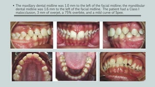  The maxillary dental midline was 1.0 mm to the left of the facial midline; the mandibular
dental midline was 1.6 mm to the left of the facial midline. The patient had a Class I
malocclusion, 3 mm of overjet, a 75% overbite, and a mild curve of Spee.
 