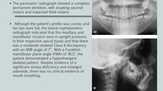  The panoramic radiograph showed a complete
permanent dentition, with erupting second
molars and impacted third molars.
 Although the patient’s profile was convex and
her lips were full, the lateral cephalometric
radiograph indicated that the maxillary and
mandibular incisors were in upright positions
in their respective apical bases and that there
was a moderate skeletal Class II discrepancy
with an ANB angle of 7°. With a Frankfort-
mandibular plane angle (FMA) of 36.5°, the
patient demonstrated a hyperdivergent
skeletal pattern. Despite evidence of a
significant airway deficiency and enlarged
adenoids, there was no clinical evidence of
mouth breathing.
 