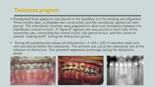 Treatment progress
 Preadjusted fixed appliance was placed in the maxillary arch for leveling and alignment.
Three months later, a biteplate was constructed, and the mandibular appliances were
placed. The orthodontic brackets were angulated to allow root divergence between the
mandibular central incisors. A “figure 8” ligature wire was placed on each side of the
osteotomy site, connecting the central incisor, the lateral incisor, and the canine to
prevent “walking teeth” during the distraction period.
 During the predistraction phase of orthodontics. A .016 x .022-in stainless-steel arch
wire was placed before the osteotomy. The archwire was cut at the osteotomy site at the
initiation of distraction. This provided segmental anchorage during the distraction
phase.
 
