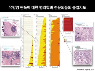 Figure 4. Participating Pathologists’ Interpretations of Each of the 240 Breast Biopsy Test Cases
0 25 50 75 100
Interpretations, %
2
4
6
8
10
12
14
16
18
20
22
24
26
28
30
32
34
36
38
40
42
44
46
48
50
52
54
56
58
60
62
64
66
68
70
72
Case
Benign without atypia
72 Cases
2070 Total interpretations
A
0 25 50 75 100
Interpretations, %
218
220
222
224
226
228
230
232
234
236
238
240
Case
Invasive carcinoma
23 Cases
663 Total interpretations
D
0 25 50 75 100
Interpretations, %
147
145
149
151
153
155
157
159
161
163
165
167
169
171
173
175
177
179
181
183
185
187
189
191
193
195
197
199
201
203
205
207
209
211
213
215
217
Case
DCIS
73 Cases
2097 Total interpretations
C
0 25 50 75 100
Interpretations, %
74
76
78
80
82
84
86
88
90
92
94
96
98
100
102
104
106
108
110
112
114
116
118
120
122
124
126
128
130
132
134
136
138
140
142
144
Case
Atypia
72 Cases
2070 Total interpretations
B
Benign without atypia
Atypia
DCIS
Invasive carcinoma
Pathologist interpretation
DCIS indicates ductal carcinoma in situ.
Diagnostic Concordance in Interpreting Breast Biopsies Original Investigation Research
Elmore etl al. JAMA 2015
유방암 판독에 대한 병리학과 전문의들의 불일치도
 