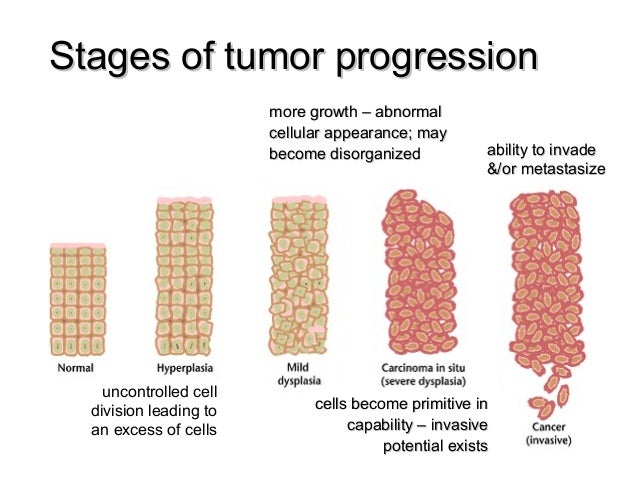 What Are The Stages Of Tumor Development? – NKAXF