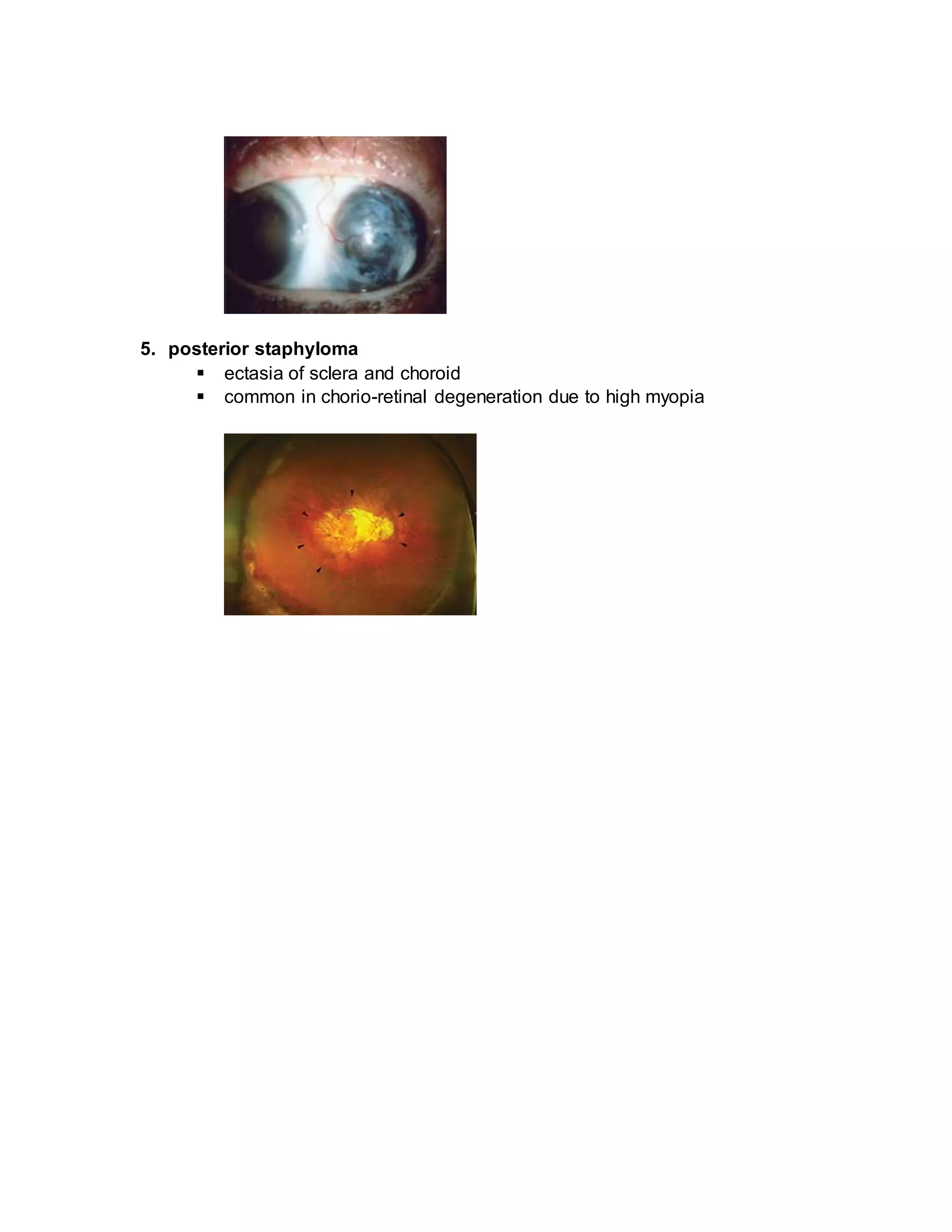 5. posterior staphyloma
 ectasia of sclera and choroid
 common in chorio-retinal degeneration due to high myopia
 