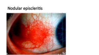 sclera-and-episclera-constitutions-in-management-of-eye-pptx