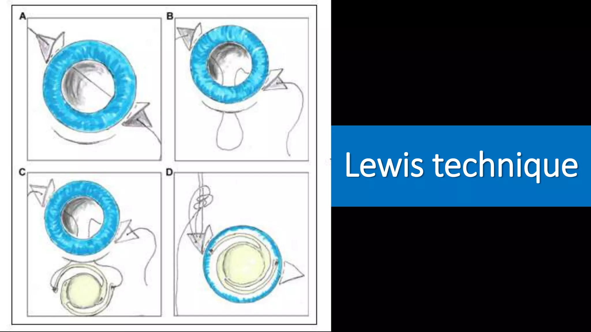Scleral fixation technique | PPTX