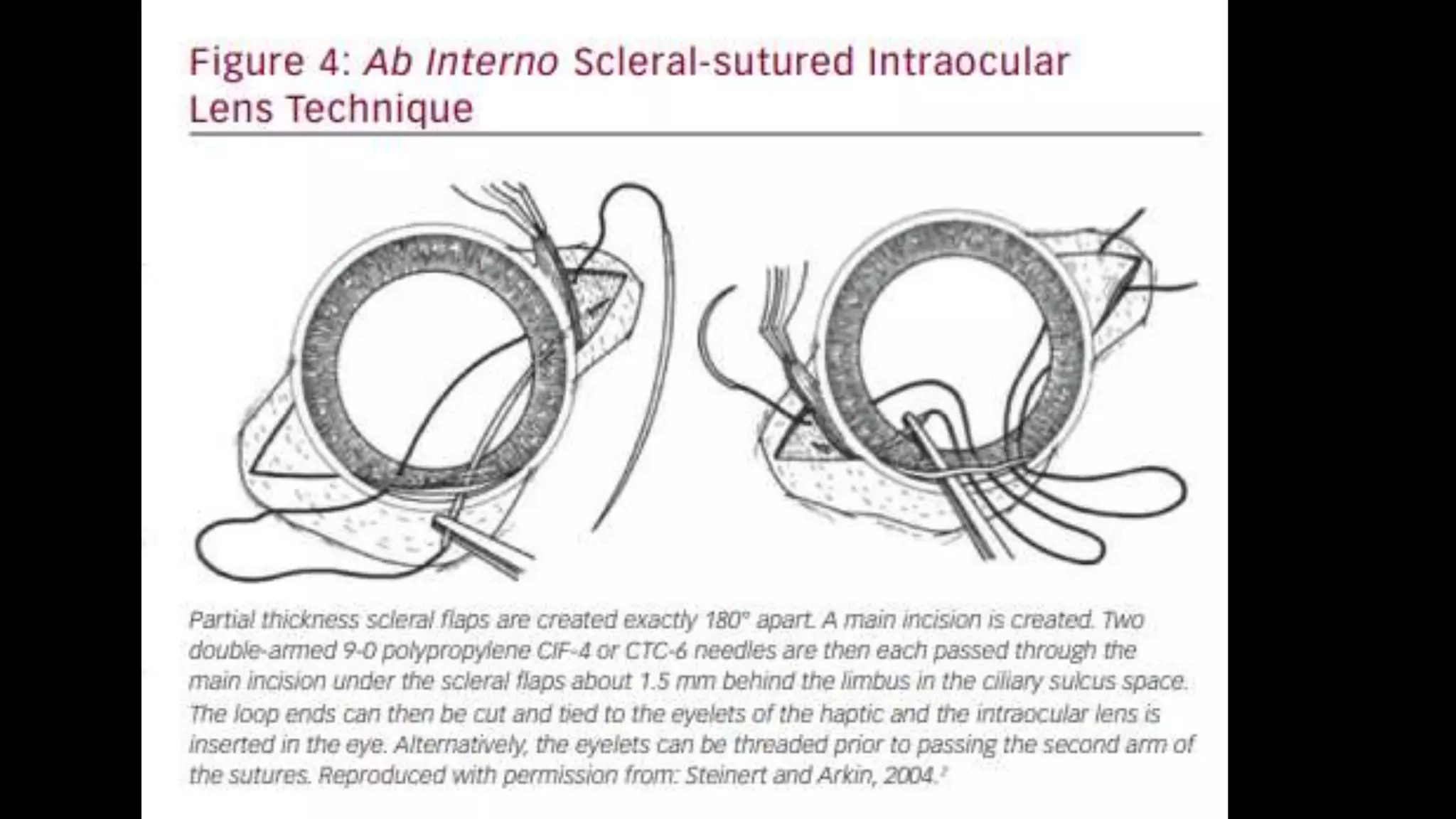 Scleral fixation technique | PPTX