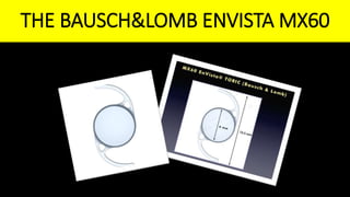 THE BAUSCH&LOMB ENVISTA MX60
 