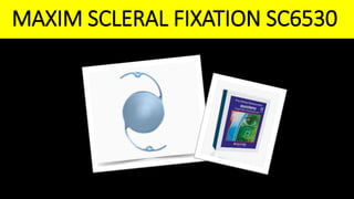 MAXIM SCLERAL FIXATION SC6530
 