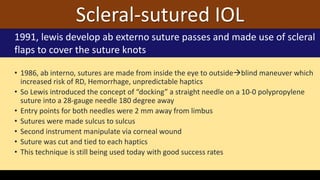 • 1986, ab interno, sutures are made from inside the eye to outsideblind maneuver which
increased risk of RD, Hemorrhage, unpredictable haptics
• So Lewis introduced the concept of “docking” a straight needle on a 10-0 polypropylene
suture into a 28-gauge needle 180 degree away
• Entry points for both needles were 2 mm away from limbus
• Sutures were made sulcus to sulcus
• Second instrument manipulate via corneal wound
• Suture was cut and tied to each haptics
• This technique is still being used today with good success rates
Scleral-sutured IOL
1991, lewis develop ab externo suture passes and made use of scleral
flaps to cover the suture knots
 