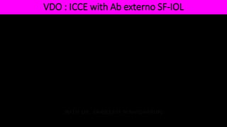 VDO : ICCE with Ab externo SF-IOL
 