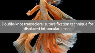 Double-knot transscleral suture fixation technique for
displaced intraocular lenses
 