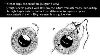 • Inferior displacement of IOL (surgeon’s view)
• Straight needle passed with 10-0 prolene suture from inferonasal scleral flap
through haptic anterior to the iris and then out to superotemporal
paracentesis site with 30-guage needle as a guide wire
 