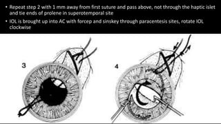 • Repeat step 2 with 1 mm away from first suture and pass above, not through the haptic islet
and tie ends of prolene in superotemporal site
• IOL is brought up into AC with forcep and sinskey through paracentesis sites, rotate IOL
clockwise
 