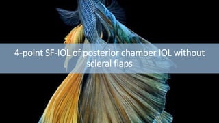 4-point SF-IOL of posterior chamber IOL without
scleral flaps
 