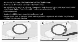 • Conjunctival peritomy at 2,8 o’clock (left eye) or 10,4 o’clock (right eye)
• Half thickness 3 mm scleral grooves 1 mm behind the limbus
• Partial thickness corneal incision 7mm at the superior or superotemporal cornea in between the sites of the
scleral incision by Bard-Parker knife no.15, then 3mm keratome enter the AC
• Anterior vitrectomy
• Double armed 10-0 prolene on straight needles were used
• Straight needle enter AC via scleral groove directed perpendicularly towards mid-vitreous and guided by a
25-guage cannula to exit the globe
 
