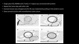 • Single piece IOL (PMMA with 2 holes in 1 haptic) was connected with prolene
• Repeat the same step with other side
• Corneal incision was enlarged and the IOL was implanted by pulling on the prolene suture
• Close corneal incision with monofilament nylon suture
 