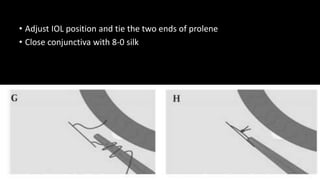 • Adjust IOL position and tie the two ends of prolene
• Close conjunctiva with 8-0 silk
 