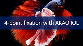 4-point fixation with AKAO IOL
 
