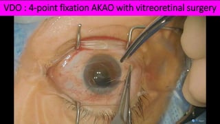 VDO : 4-point fixation AKAO with vitreoretinal surgery
 
