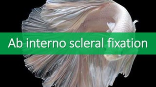 Ab interno scleral fixation
 