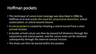 Hoffman pockets
• This technique of suture knot coverage was described in 2006 by
Hoffman et al and avoids the need for conjunctival dissection, scleral
cauterization, or scleral wound closure.
• A scleral pocket is created by initiating a scleral tunnel from a clear
corneal incision.
• A double-armed suture can then be passed full thickness through the
conjunctiva and scleral pocket, and the suture ends can be retrieved
subsequently through the external corneal incision.
• The knots can then be buried within the pockets.
 