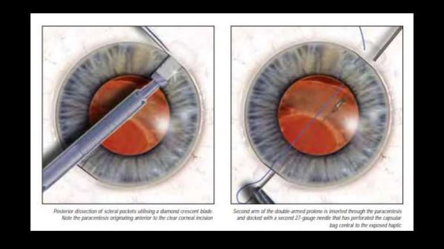 Scleral fixation technique | PPTX
