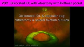 VDO : Dislocated IOL with vitrectomy with Hoffman pocket
 