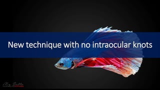 New technique with no intraocular knots
 