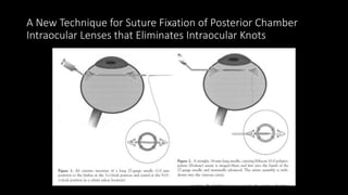 A New Technique for Suture Fixation of Posterior Chamber
Intraocular Lenses that Eliminates Intraocular Knots
 